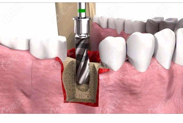 种植牙的植入过程