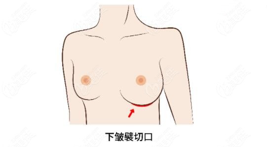潘峰医生独特下皱襞隆胸技术