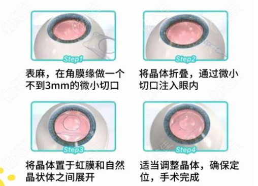 武汉晶体植入手术过程