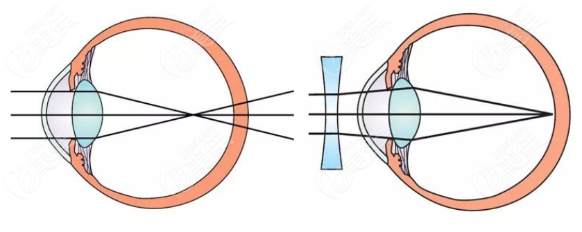 武汉近视矫正前后对比
