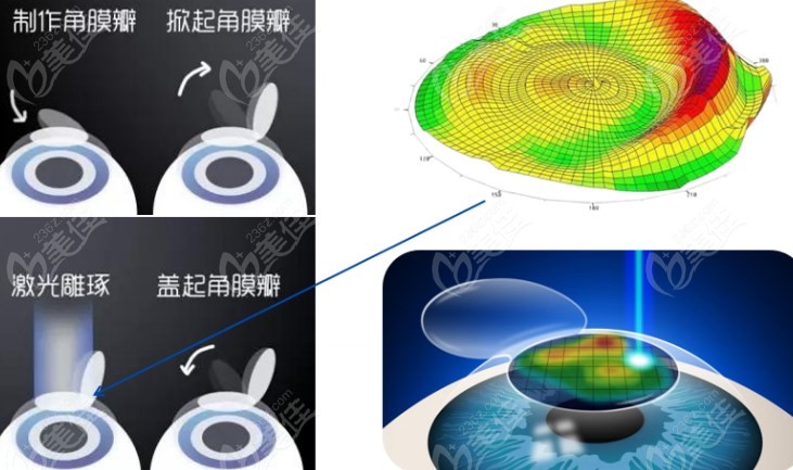 近视眼矫正手术半飞秒激光236z.com