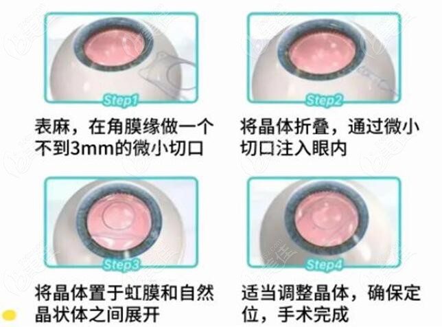 银川做晶体植入矫正近视的原理图