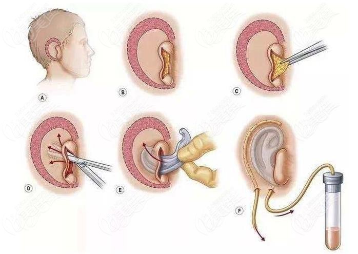 广西肋软骨直埋耳再造术价格