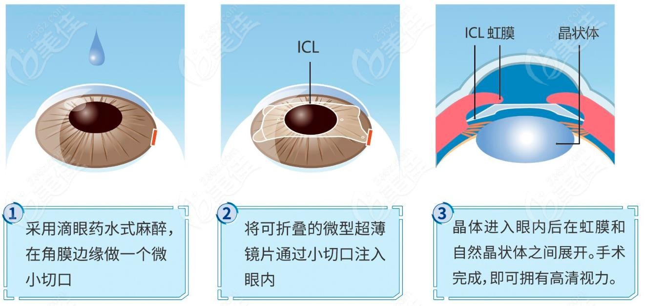 南宁晶体植入近视眼手术价格