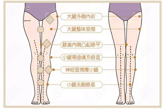 深圳治疗O型腿哪个医院比较好？www.236z.com