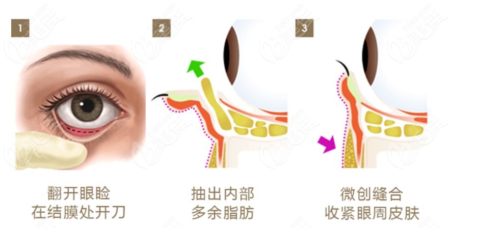 健麗祛眼袋手術(shù)全過程圖解美佳網(wǎng)