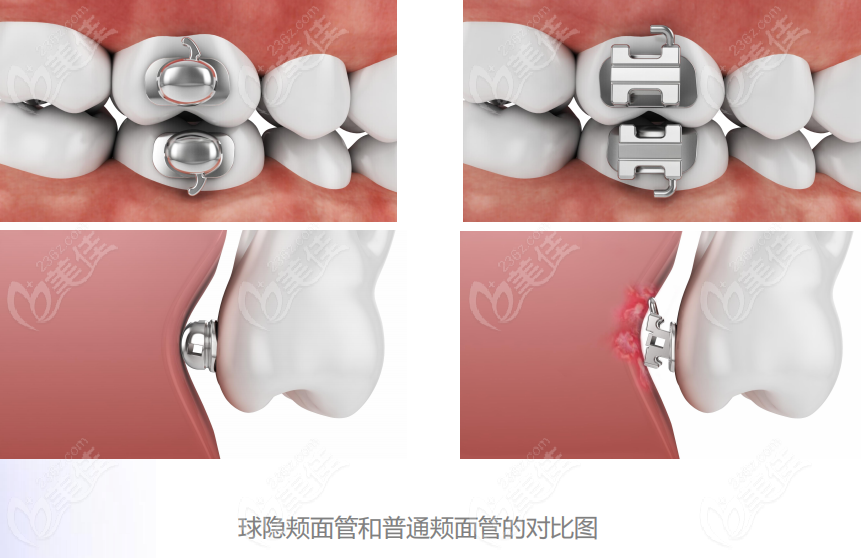 广州欧欧托槽对口腔的接触
