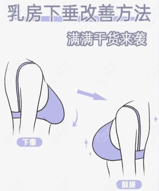 穿胸托可以改善胸下垂吗