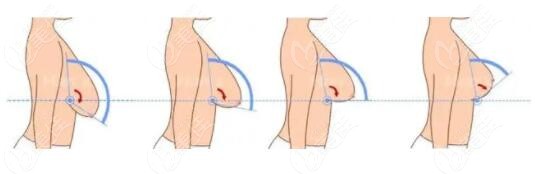 中重度胸部下垂做乳房下垂提升手术怎么做