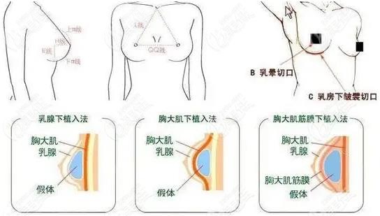 南宁创可贴丰胸推荐南宁格林美菲