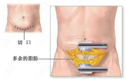 腹壁整形手术图示236z.com