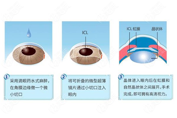 近视手术之ICL晶体植入