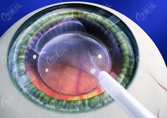 ICL人工晶体植入近视手术