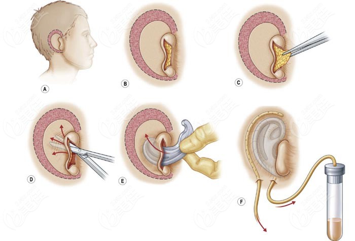 国内常见的耳再造手术原理图www.236z.com