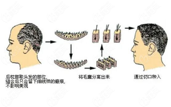 男士能做的美容项目植发手术