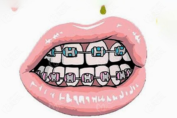为什么暑期学生做牙齿矫正有优惠呢