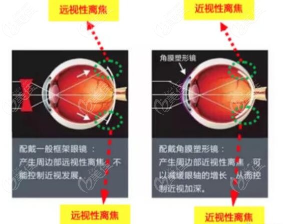 成人ok镜佩戴需要什么条件