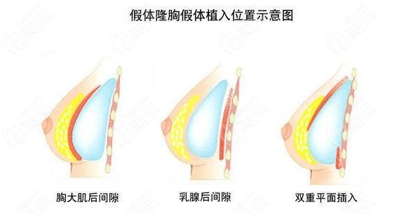 内窥镜双平面隆胸手术示意图