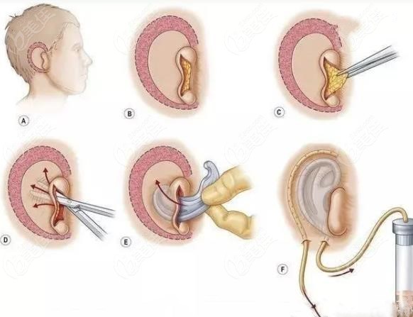 全包法耳再造手术过程图解