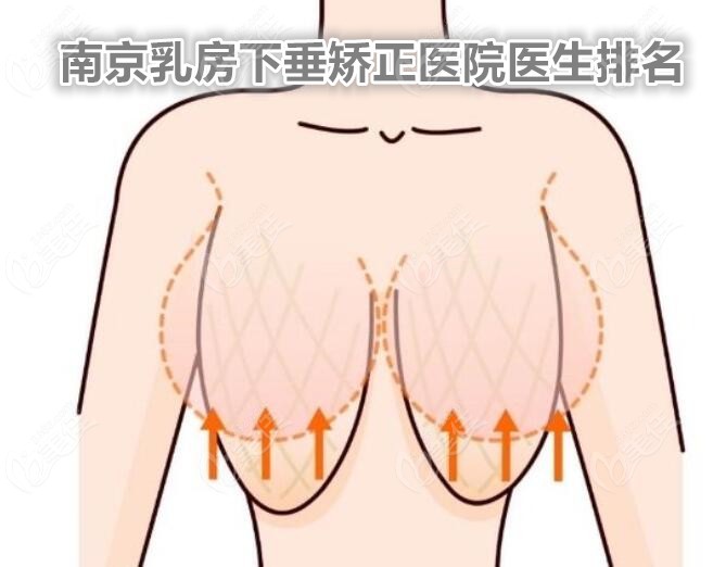南京乳房下垂矫正医院医生排名