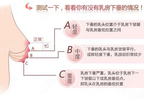 罗盛康结合胸下垂程度矫正提升