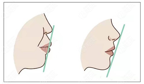 玻尿酸改善嘴凸前后对比
