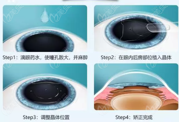  千叶眼科医院做icl晶体植入真实经历