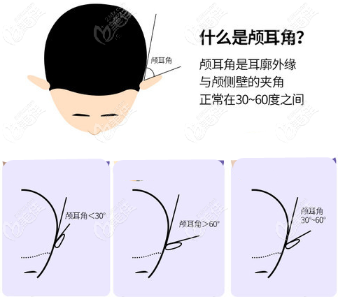 网红精灵耳朵手术过程