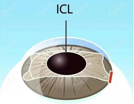 icl晶体植入手术视力能恢复到正常范围吗