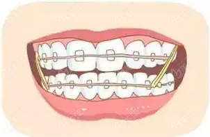 杭州上城区雅莱齿科牙齿矫正价格