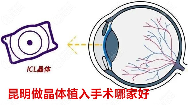 昆明做晶体植入手术哪家好