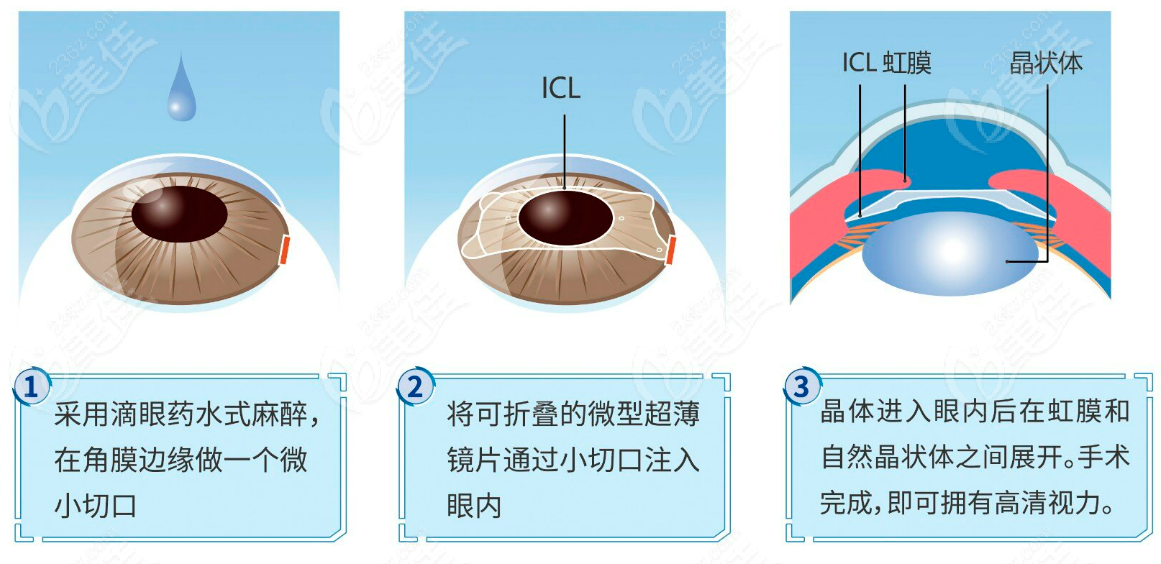 做完晶体植入手术应该注意些什么