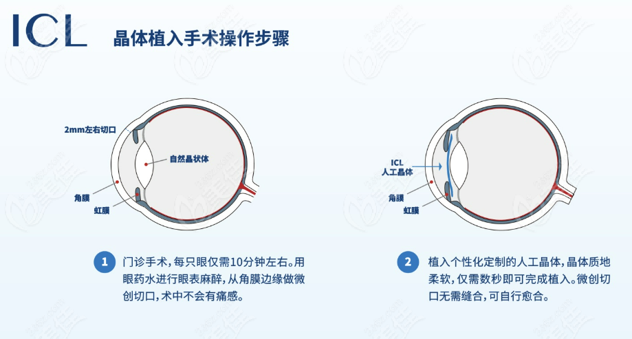 做完晶体植入手术多久可以看手机