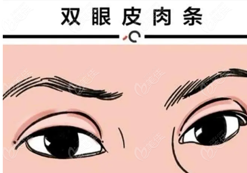 上海陈红梅医生双眼皮修复价格