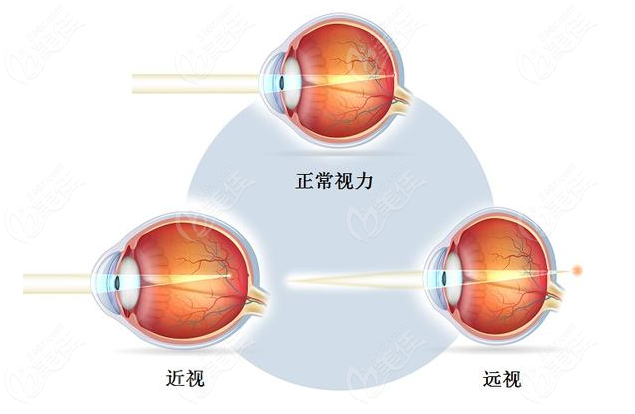 在惠州做全飞秒激光近视手术价格