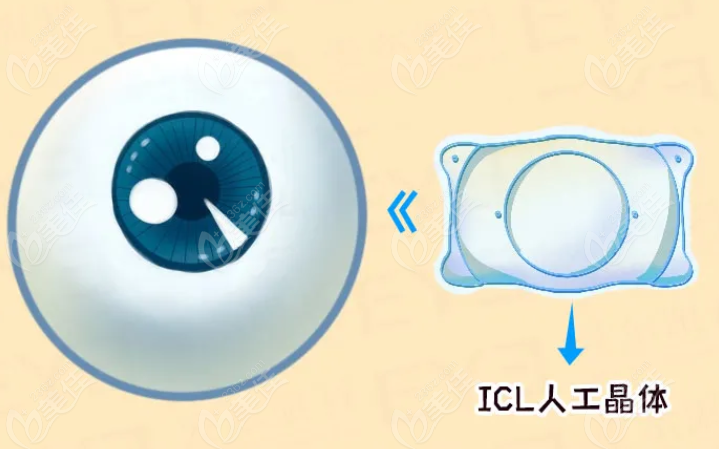 西安眼科icl晶体植入技术好