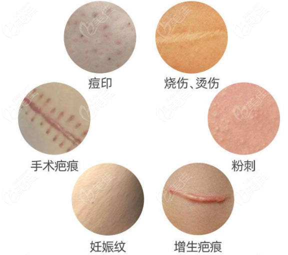 疤痕增生治疗好的医院可以改善疤痕类型236z.com