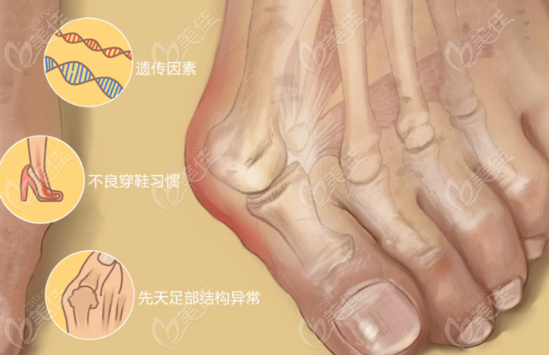 成都友谊医院拇外翻医生哪个好 236z.com