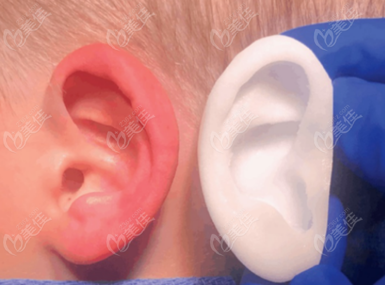 舒铂耳再造支架与真耳相似度高