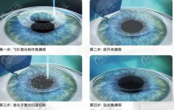 国内激光近视手术医院排名 236z.com
