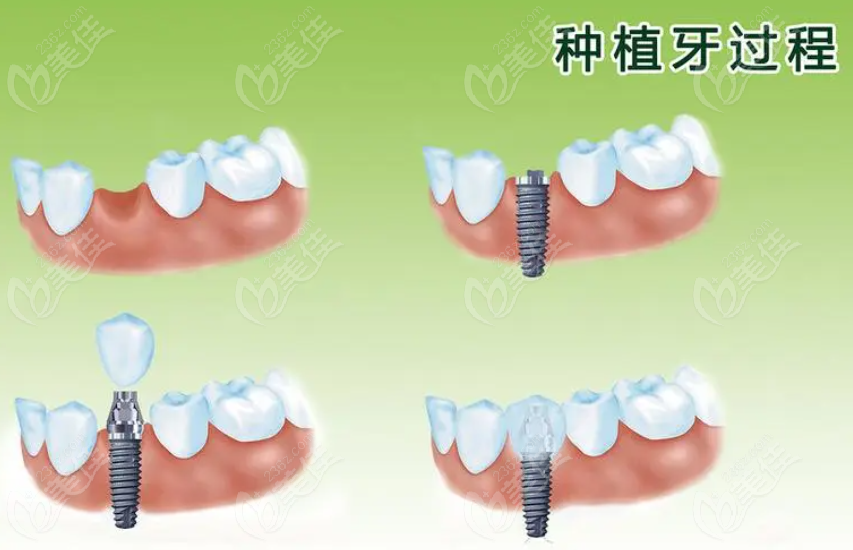 德韩口腔种植牙流程236z.com