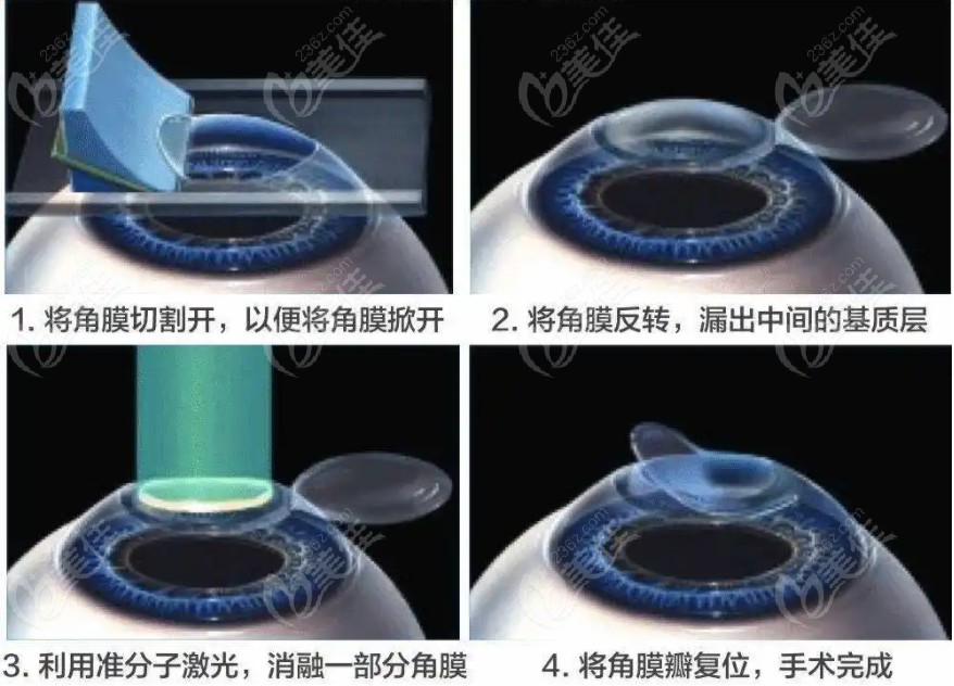 激光近视眼手术过程