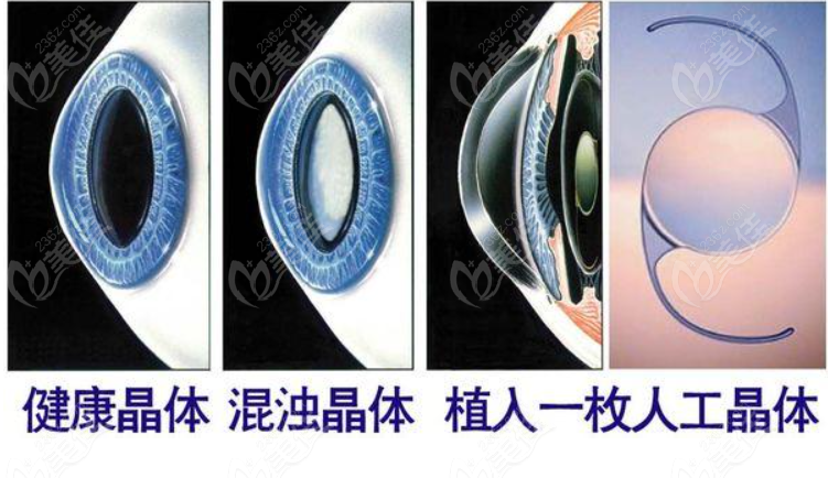 从视觉质量看，白内障晶体进口比国产好