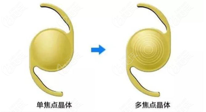 白内障晶体单焦和多焦的区别