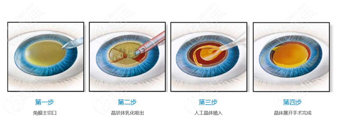 白内障人工晶体植入手术怎么做