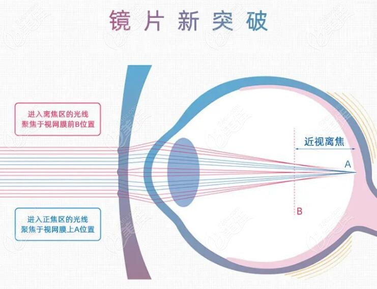 离焦镜片真的能控制近视吗？