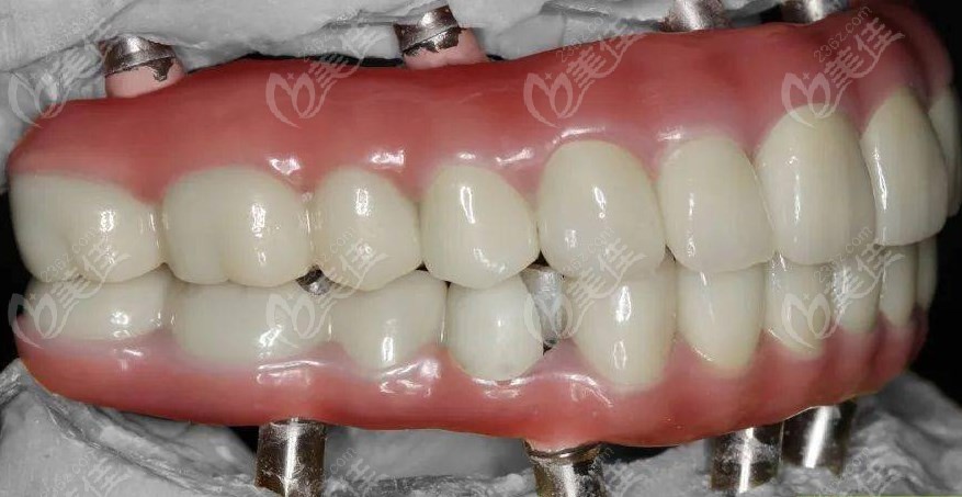 all-on-6种植牙技术