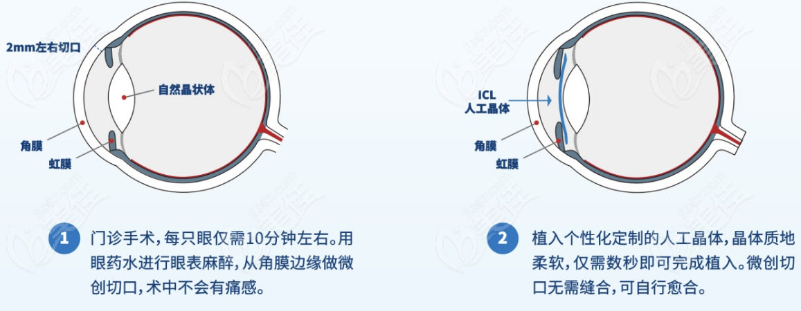 燕振国做晶体植入手术例子