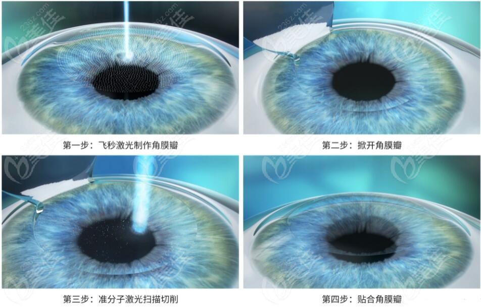 燕振国做全飞秒手术实例www.236z.com