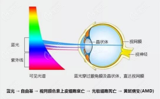 做完近视手术可以戴防蓝光眼镜